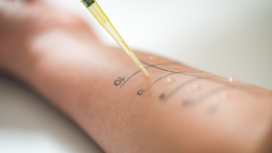 Diagnosen latexallergi kan ställas genom hudpricktest eller blodprov. Foto: Shutterstock